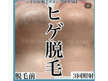 ツバキ(TSUBAKI)/ヒゲ脱毛