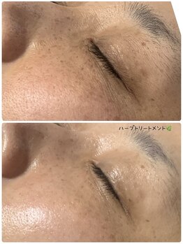 サロンドボーテ オランジュ(salon de beaute Orange)/ハーブトリートメント