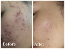 ノア 新宿(Noa)/ハーブピーリング＋マシン 10回