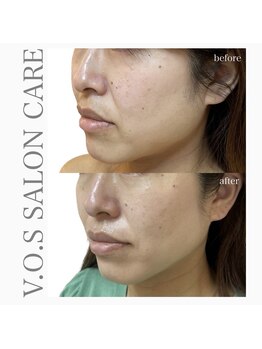 ルーナ(Runa)/■VOSサロンケア【ホワイト】