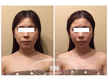 美極 銀座店/銀座/小顔コルギ/小顔矯正