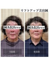 わきさか鍼灸整骨院・鍼灸院 レーヴ(Reve)/