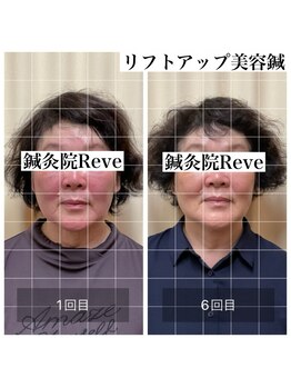 わきさか鍼灸整骨院・鍼灸院 レーヴ(Reve)/