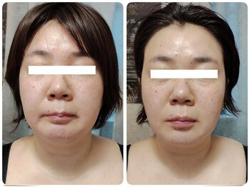 ティアス(t-us)/【小顔・痩身】脂肪分解