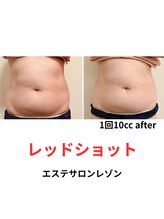 レゾン 京橋店/下腹ぽっこり対策☆最新韓国美容