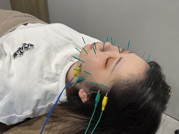葵整骨院 はりきゅう院 平松本町院の写真/美容鍼で素肌美人に！初めての方も歓迎♪お客様一人ひとりに合わせて根本改善！ほうれい線、たるみケアも◎