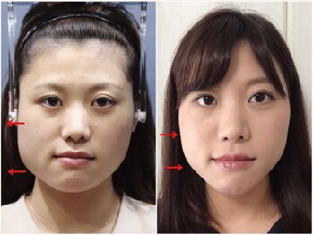 さつま骨格矯正 HRD広尾 西麻布院 /歪み小顔矯正 BeforeAfter