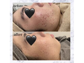 シュバル(CHEVAL)/ニキビケアにはBBLでしょ！