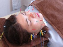 高田鍼灸カイロプラクティック/電気美容鍼で一気に引き上げ！