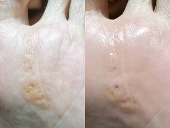 ドイツ式フットケア