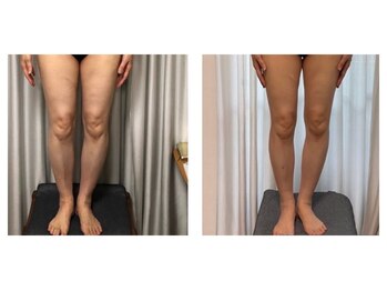 中目黒下半身ダイエット専門整体サロン/ビフォー(左) アフター(右)