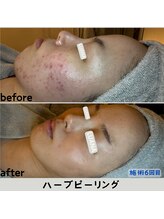 ルアナ 北谷店/ハーブピーリング 《沖縄/北谷》