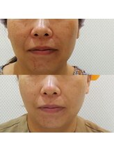 マリー エクラン/50代女性　シミ改善