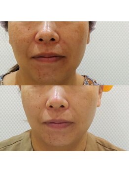 マリー エクラン/50代女性 シミ改善