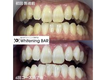 ホワイトニングバー 福島店/6回コース終了ビフォーアフター