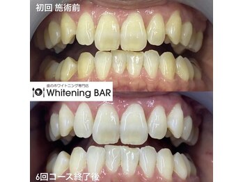 ホワイトニングバー 福島店/6回コース終了ビフォーアフター