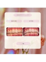 プラスビーセルフ(+b self)/ホワイトニングビフォーアフター