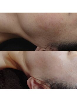 ボーソリューション(Beau-Solution)/【40代　シミ・角質ケア】