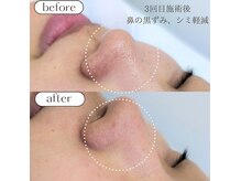 ケアプラスの雰囲気（小鼻の黒ずみもスッキリ）