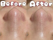 グラシア 倉敷店(Gracia)/お客様症例事例ハイドラ毛穴洗浄