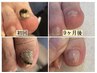 変形爪・肥厚爪・分厚い爪のトータルフットケアコース