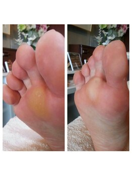 フットスタジオ アルク(FOOT STUDIO ALUK)/【角質ケアクイック30分】