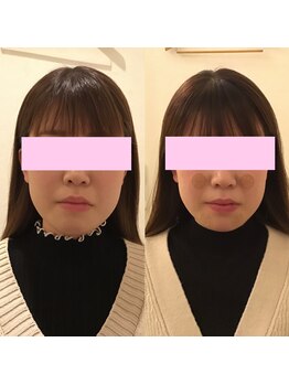 ユズ(yuzu)/◆顔の歪が気になる