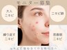 ＊赤みニキビや凹凸肌でお悩みの方へ(女性)専用モニター＊ピーリング３回～