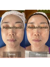 ハナン(Hanan)/ナノカレントで即日小顔に！