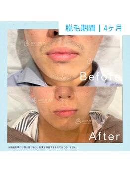 メンズクリア ららぽーと和泉店/【メンズクリア】お客様の施術例