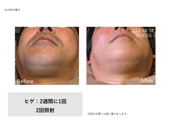 フェレザ 新潟(Felleza)/高出力で濃いヒゲ対応◎