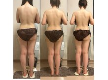 オーシャンブルーム 目黒(OceanBloom)/リンパマッサージハイパーナイフ