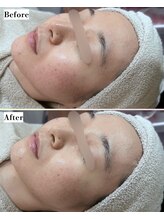 ソワナ(soina)/【神楽坂駅/フェイシャル/毛穴】