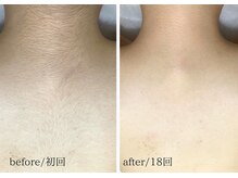 脱毛専門サロン エリクサー(Elixir)の雰囲気（手の届かない箇所シェービングはお任せください！）