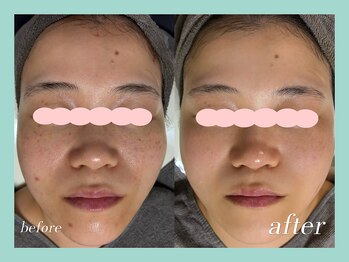 ミウル 天王寺店(miulu)/30代/ハーブピーリング１回