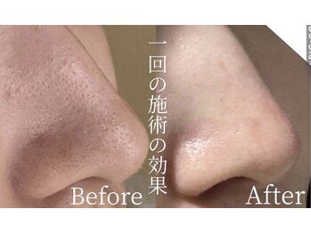 ラムール(L'amour)/ハーブピーリングで結果出し