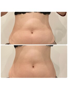 ルナート(Lunart)/おへその形に注目!腸もみ