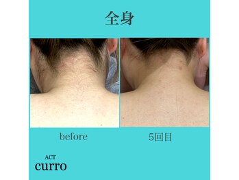アクト クロ(ACT curro)/【全身（顔・VIO込】脱毛施術例