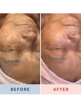 サロン ド マーシャ(salon de Marsha)/ホワイトスノーピール