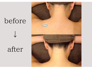 アネーロ(anhelo)/うなじ脱毛！