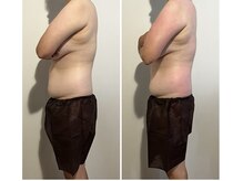 ボンダイボディー(Bondi Body)/上半身痩身1回目