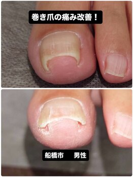 巻き爪じゅん 船橋店/巻き爪の痛みで悩みの方が笑顔に