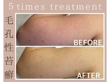 ハーブピーリング 恵比寿の写真