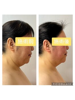 ケセラネイルケアの写真/ほうれい線・シワ・たるみ改善！小顔効果も◎あなたの美しさを引き出すお手伝いをいたします！