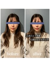 フィジオリハ 久屋大通店/美容筋膜リリース～フェイス～