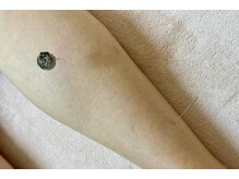 命水鍼灸院/むくみ改善【新宿/鍼灸】