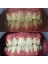 ハリス(HARIS)/セルフホワイトニング