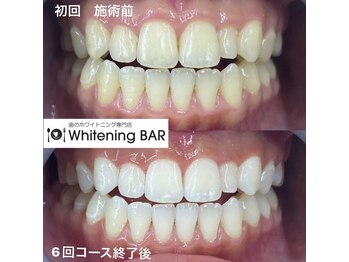ホワイトニングバー 福島店/6回コース終了ビフォーアフター