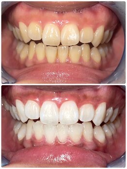 エクシアホワイトニング 札幌中島公園店/Before After［ホワイトニング］