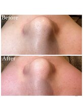 マドモアゼル 麻布十番/毛穴洗浄